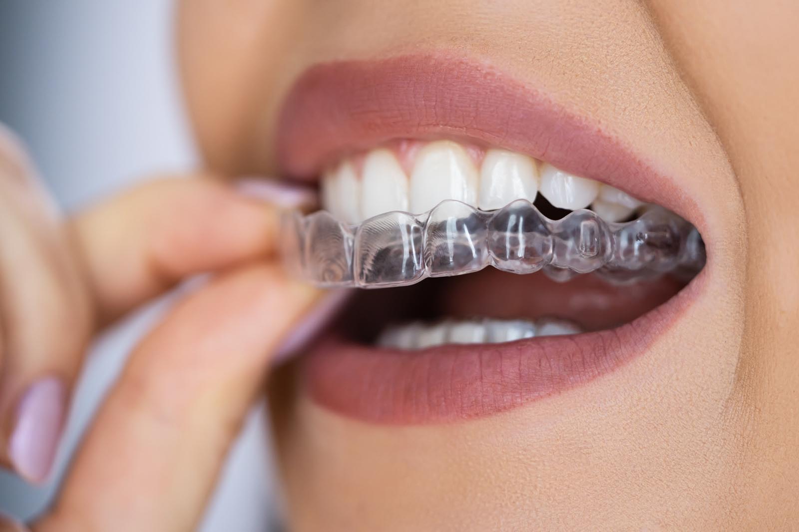 Retainers